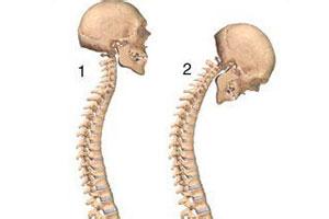 强直性脊柱炎女性患者的症状有哪些